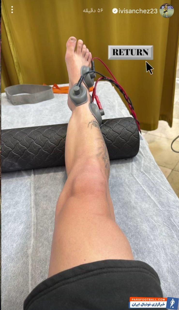 باز کردن گچ پای مصدوم ایوان سانچس ستاره سپاهان