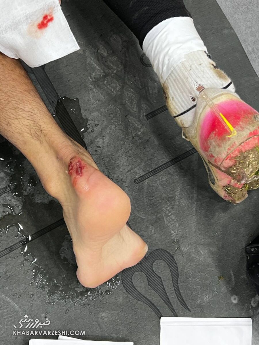 416515 تصویر دلخراش بازیکن خیبر/ ضربه مهاجم استقلال کارت قرمز داشت؟ +عکس