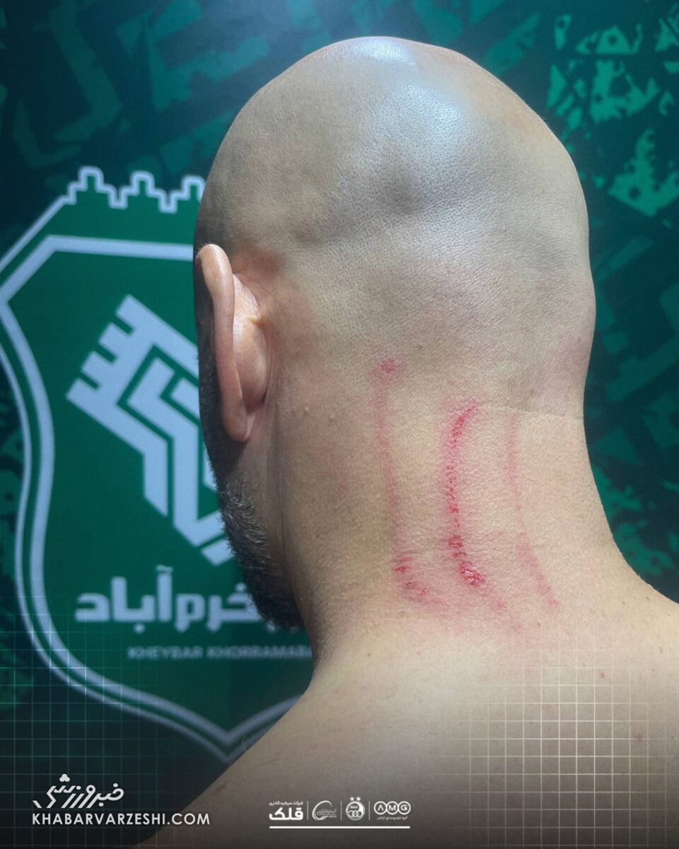 حمله به ساپینتو و زخمی شدن مربی استقلال/ جای پنجه پشت گردن جورجیوس اسکیاتیتیس +عکس