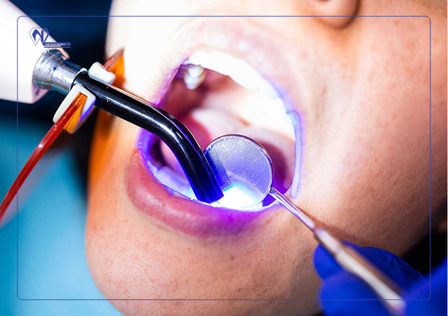 چه خوراکی‌هایی عمر کامپوزیت دندان را به خطر می‌اندازد؟