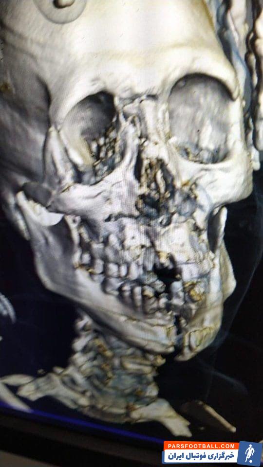  تلخ و باورنکردنی: جمجمه یاسر الشهرانی خرد شد! + عکس