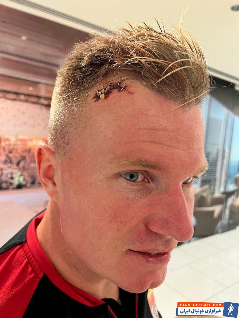 فولاد ؛ ده بخیه روی سر کریستوفر کنت