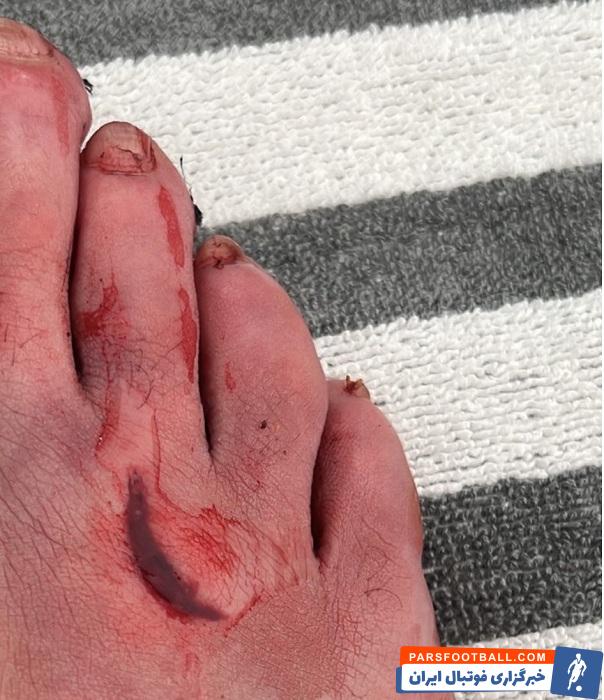 رئال مادرید ؛ زخم پای بنزما پنج بخیه خورد