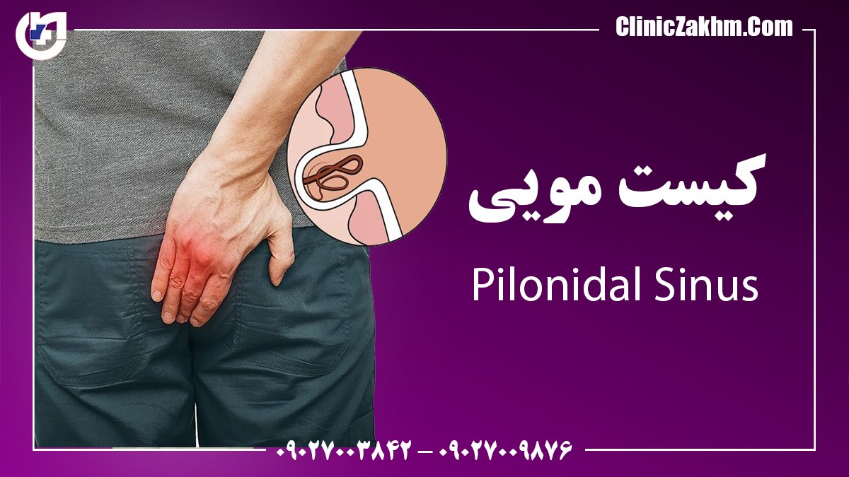 کیست مویی از علائم اولیه تا روش های درمان و مراقبت های بعد از آن