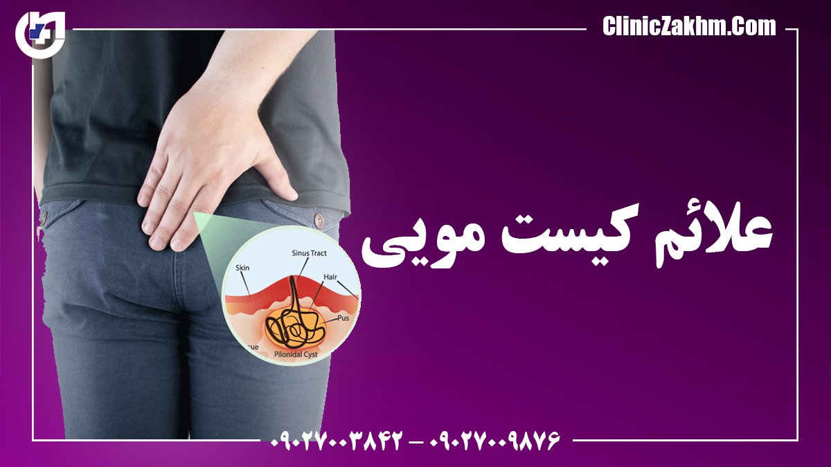 کیست مویی از علائم اولیه تا روش های درمان و مراقبت های بعد از آن