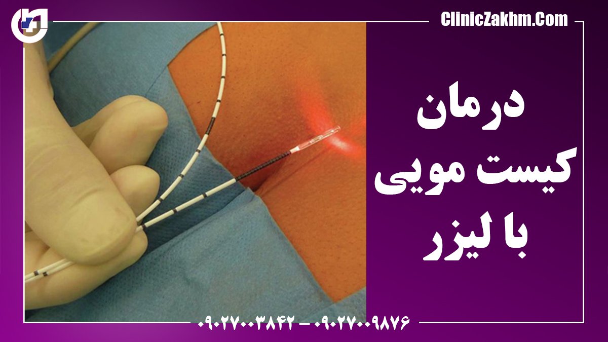 کیست مویی از علائم اولیه تا روش های درمان و مراقبت های بعد از آن