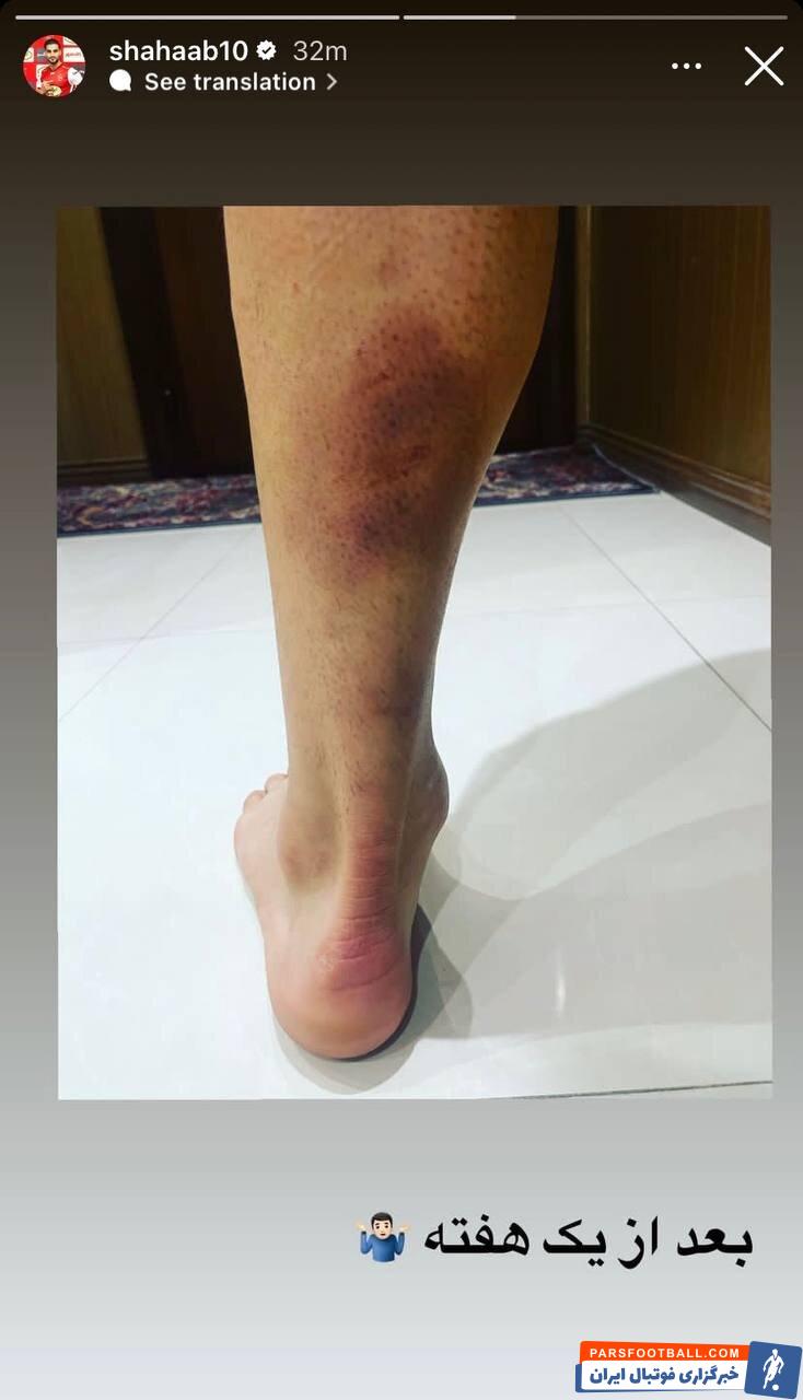 عکس| اعتراض خلاقانه یک پرسپولیسی؛ رونمایی از تصویر کبودی پا و لحظه پنالتی!