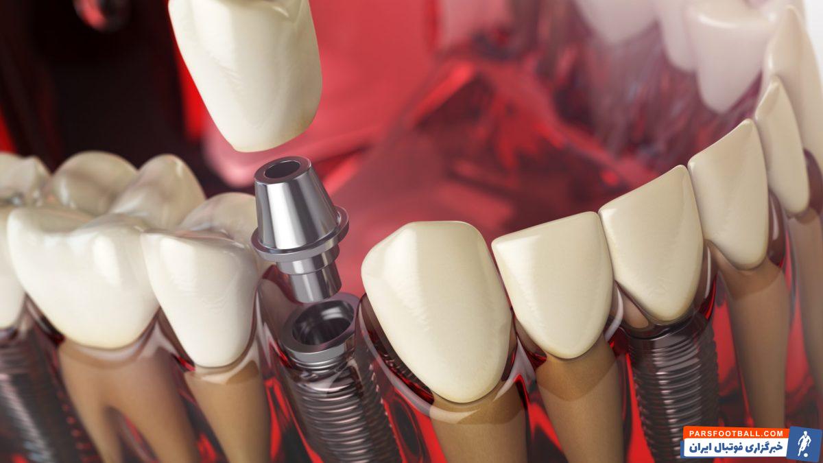 علائم جوش نخوردن ایمپلنت چیست ؟