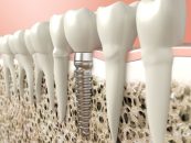 علائم جوش نخوردن ایمپلنت چیست ؟