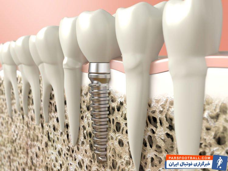 علائم جوش نخوردن ایمپلنت چیست ؟