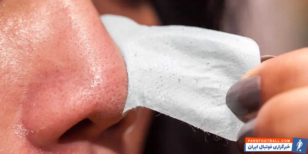 راهکارهای موثر برای درمان جوش سر سیاه