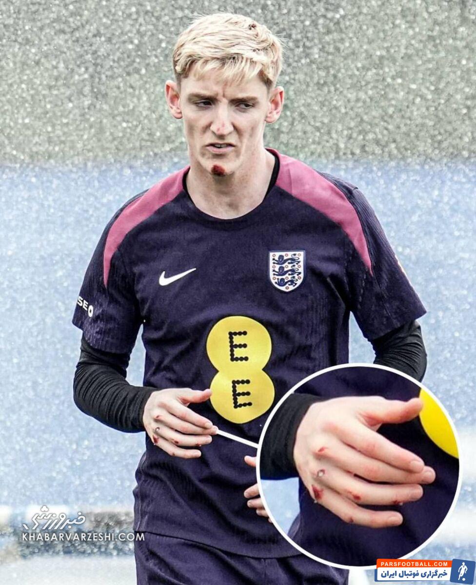 عکس| ستاره انگلیس به دلیل سقوط از دوچرخه مصدوم شد!