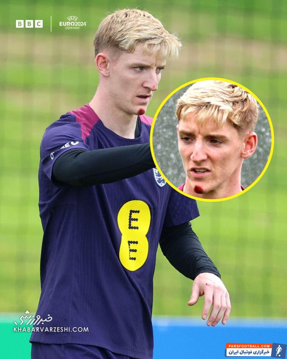 عکس| ستاره انگلیس به دلیل سقوط از دوچرخه مصدوم شد!