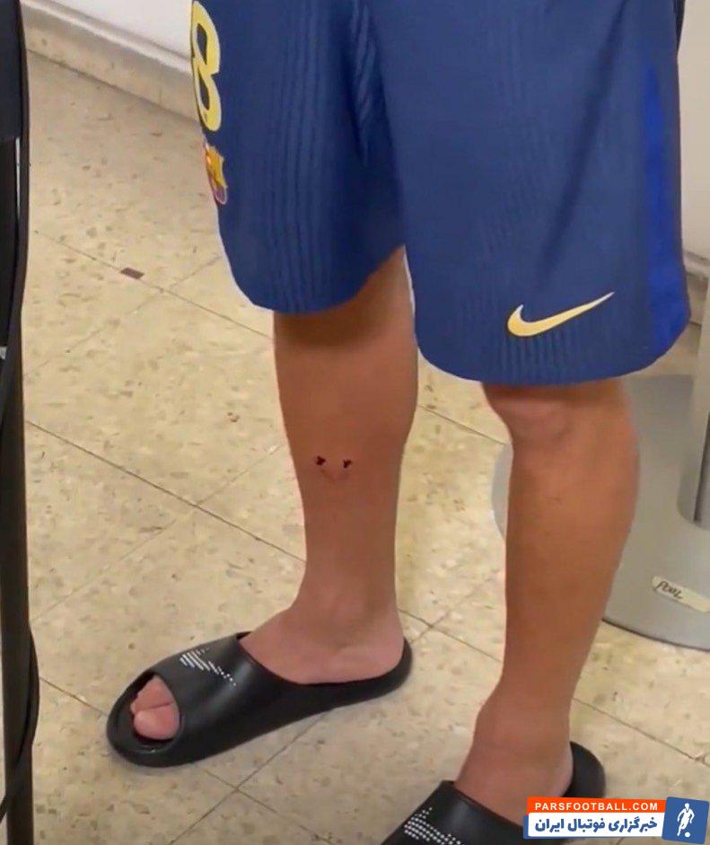 بارسلونا ؛ تصاویری از زخم پای پدری بازیکن بارسلونا