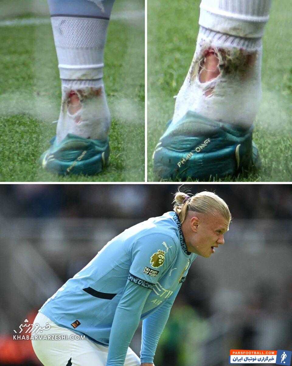 مصدومیت عجیب هالند مقابل نیوکاسل/ مچ پای بچه غول را قلم کردند! +عکس