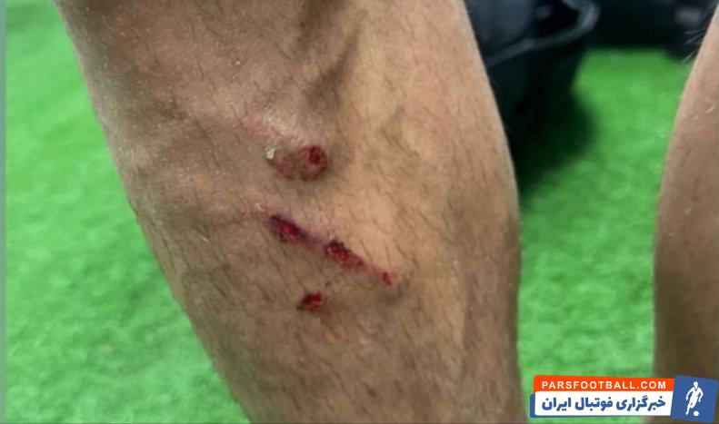 فرشاد فرجی در دربی مقابل استقلال با مصدومیت سختی مواجه شد