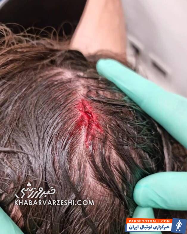 سر زلاتان را شکستند +عکس