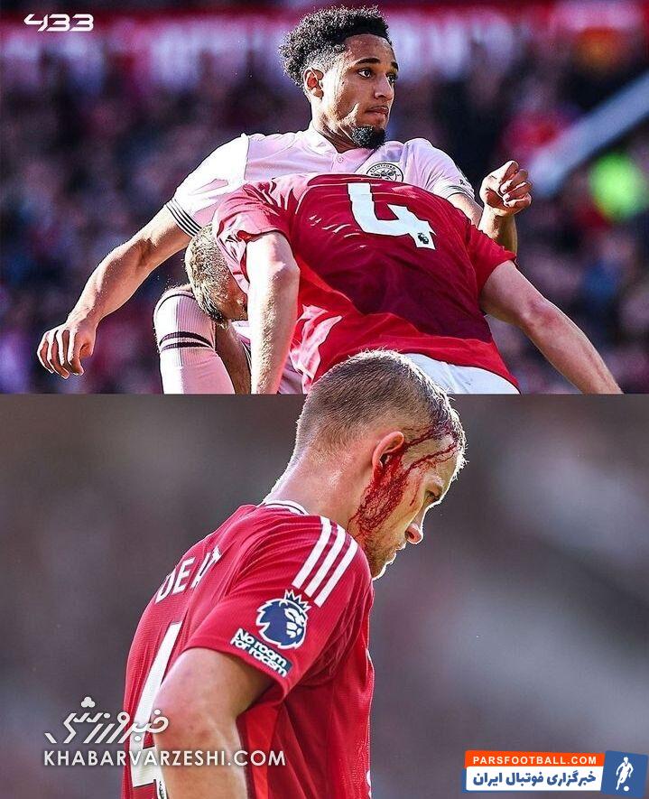 عکس| مصدومیت وحشتناک مدافع منچستریونایتد/ بازی با صورت خونآلود!