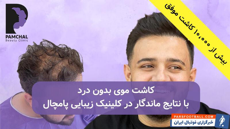 نمونه کاشت مو در کلینیک زیبایی پامچال