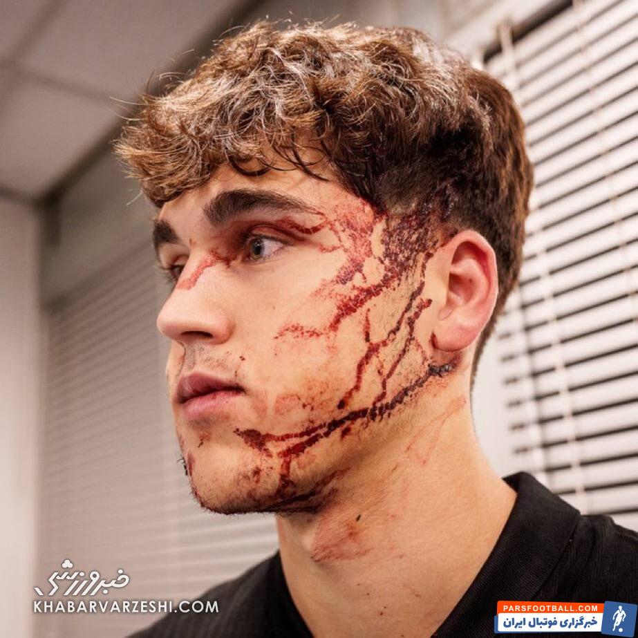 عکس| مصدومیت وحشتناک مدافع بارسلونا در بلگراد؛ صورت زخمی ۲! +ویدیو