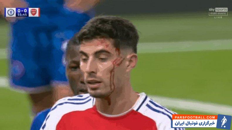 هاورتز ؛ تصویر خونریزی سر هاورتز ستاره آرسنال در دیدار برابر چلسی 