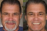 بررسی عوامل موثر قیمت ایمپلنت دندان در سال 1404