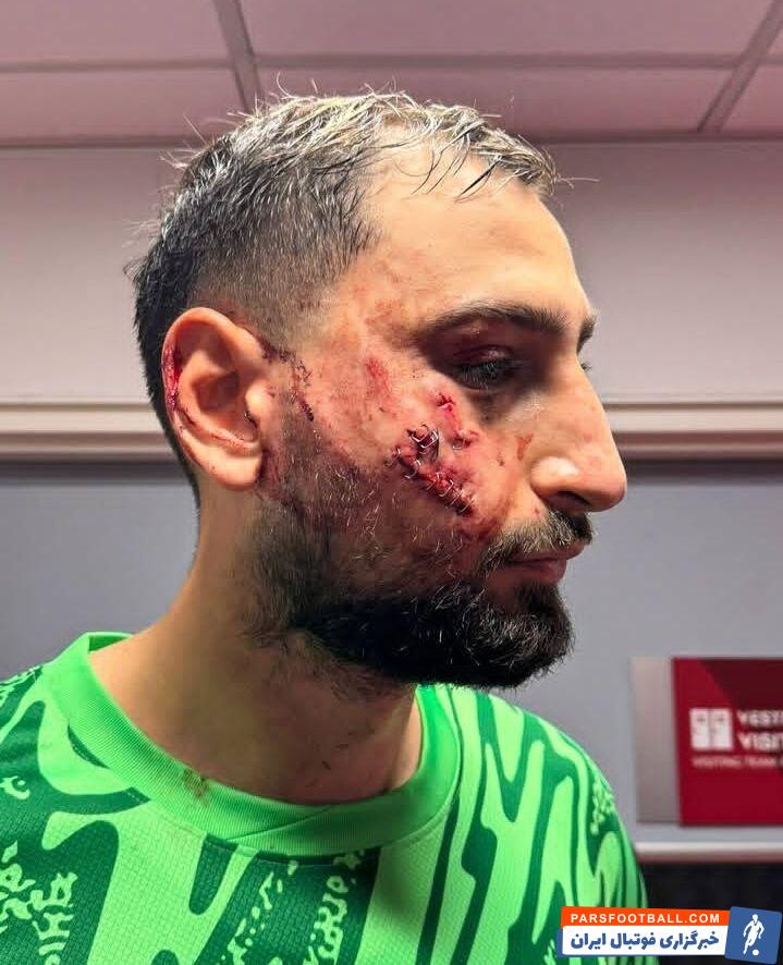 وضعیت صورت دوناروما بعد از آسیب وحشتناک/ هشدار تصویر دلهره آور!