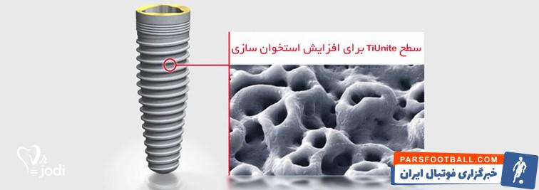 بررسی عوامل موثر قیمت ایمپلنت دندان در سال 1404