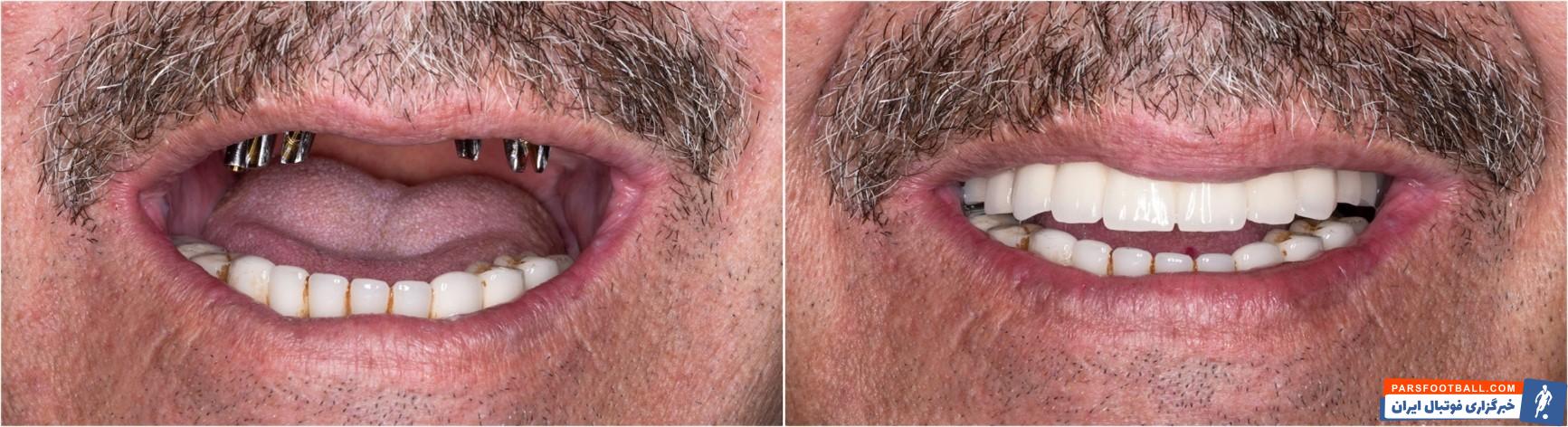 بررسی عوامل موثر قیمت ایمپلنت دندان در سال 1404