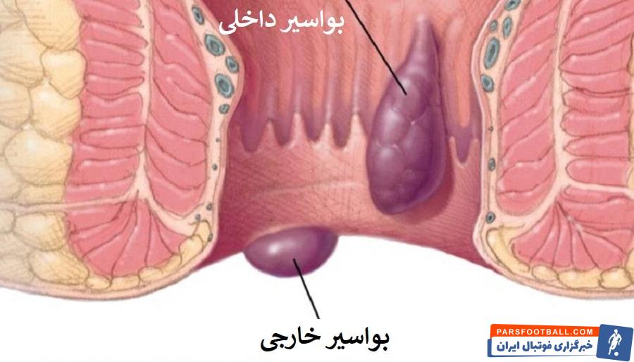 عکس بواسیر در ورزشکاران