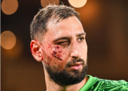 دوناروما ؛ تصویری از دوناروما گلر پاری سن ژرمن با بانداژ روی صورت