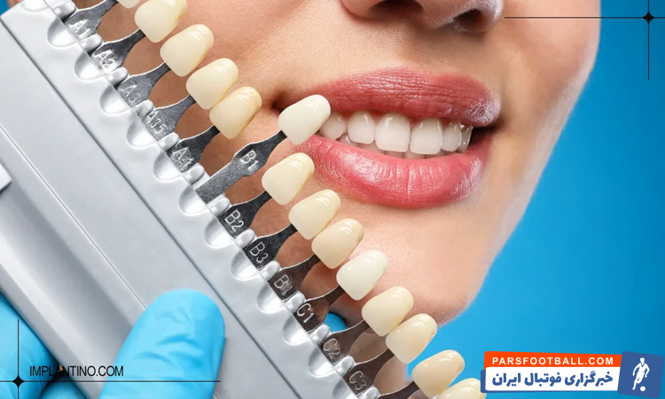 آشنایی با انواع رنگ لمینت دندان