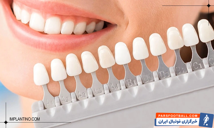 آشنایی با انواع رنگ لمینت دندان​