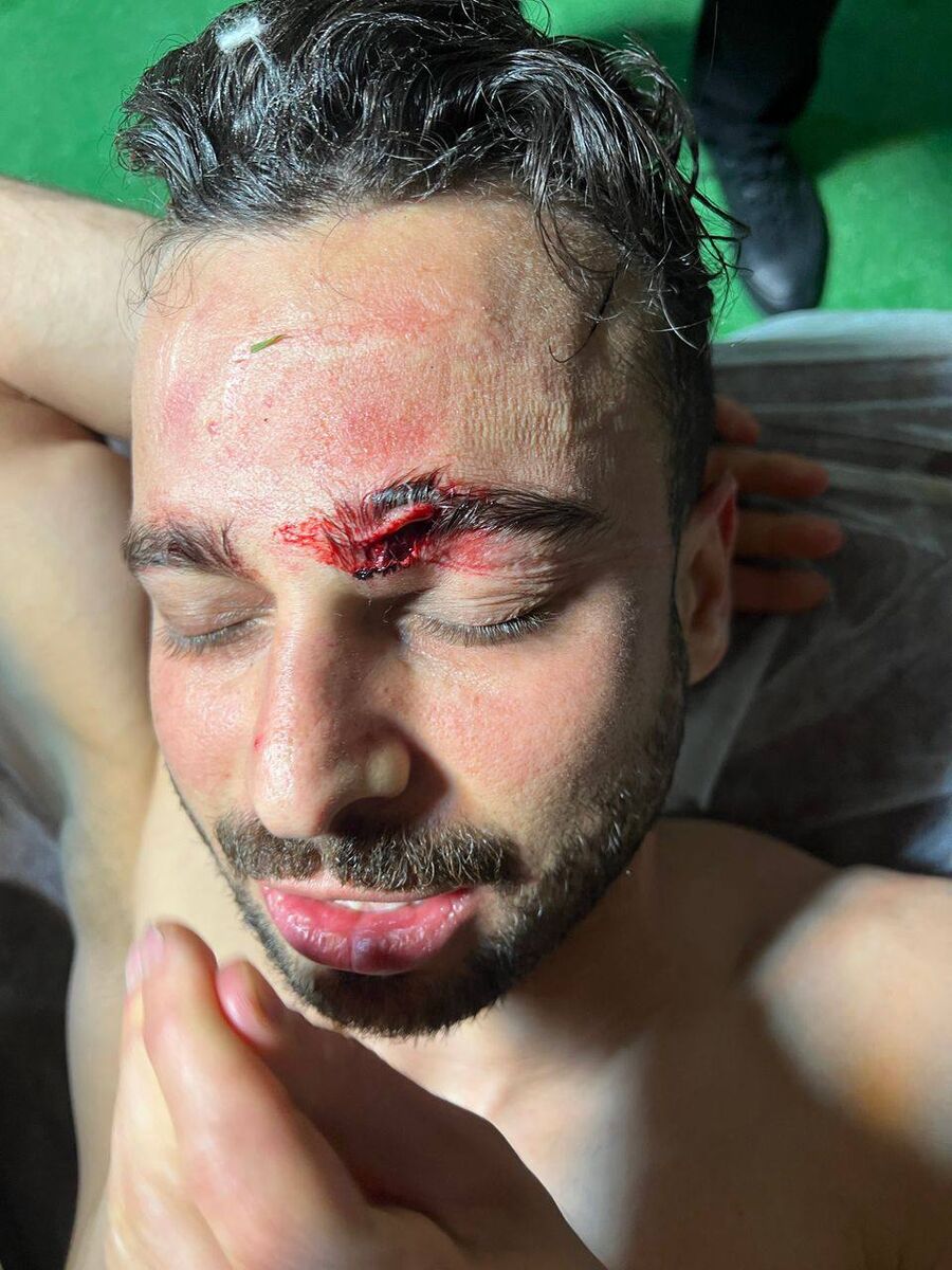 سروش رفیعی شش بخیه خورد +عکس