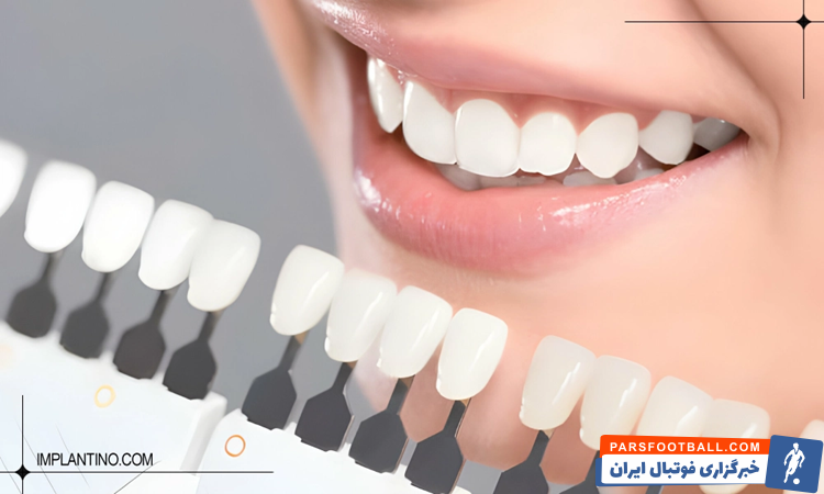 آشنایی با انواع رنگ لمینت دندان​