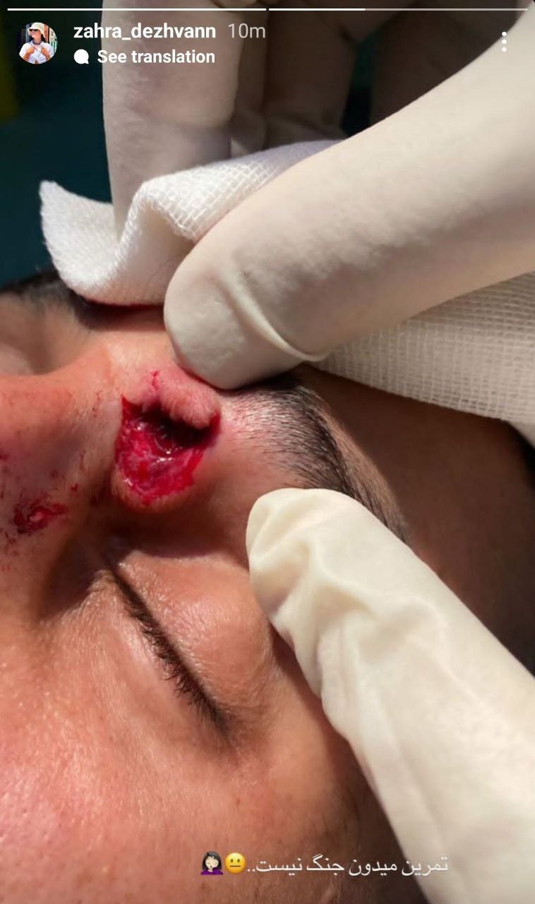 img_20250803_201510_066 عکس از استوری همسر علی علیپور از جراحت علیپور