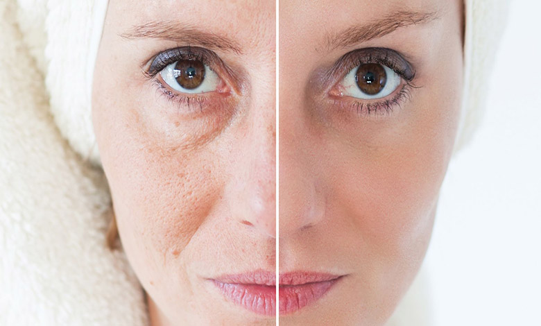 1sfv8lrmmdtwlndcjkh5pez7kxqn0dxaewth1ltu بهترین روش های جوانسازی صورت