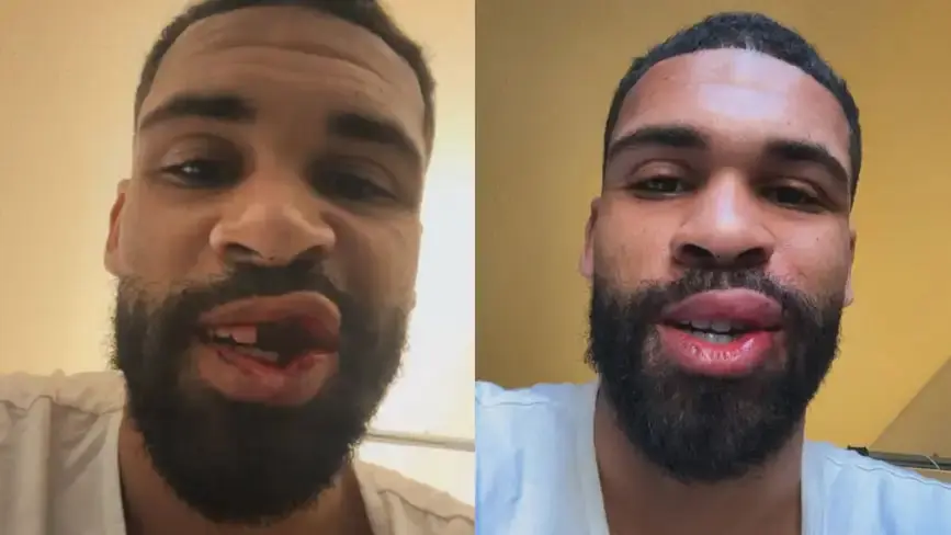 مصدومیت شدید ستاره میلان (عکس)