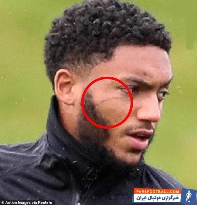 در این درگیری رحیم استرلینگ با یک ضربه شدید صورت جو گومز را هدف قرار داده بود فردای این درگیری عکسهایی از مدافع لیورپول منتشر شد که تعجب همگان را برانگیخت.