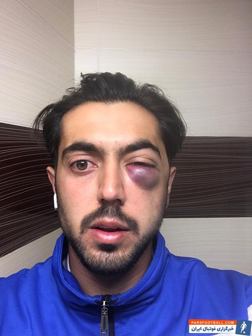 مهرداد عبدی و محمد قریشی دو بازیکن تیم های گل گهر و صنعت نفت آبادان برای زدن توپ به هوا پریدند مهرداد عبدی توپ را زد و مصدوم شد.