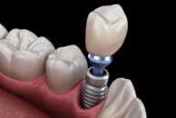 هرآنچه باید از ایمپلنت دندان بدانید