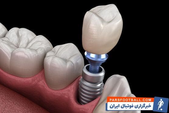 هرآنچه باید از ایمپلنت دندان بدانید