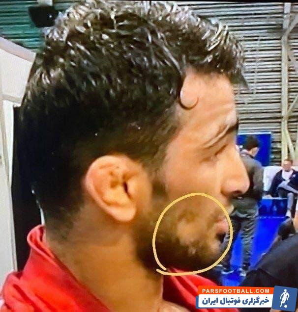 این عارضه حسن یزدانی خطرناک نیست و معمولا با تزریق آمپول های مخصوص به نواحی کچل شده، موها بعد از مدتی دوباره رشد می کنند.